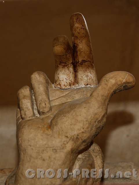 2015.07.29_12.09.25.jpg - Zwei Finger, die vor Jahrzehnten ersetzt wurden, werden wieder gänzlich ersetzt.